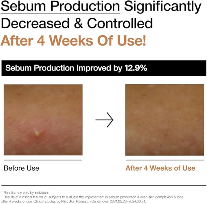 Before and after images showing reduced sebum production on skin after 4 weeks of using Anua Rice Milk Moisturizer