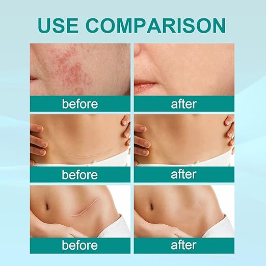 Before and after use comparison of Souqzila medical grade scar spray showing reduced redness and scar visibility