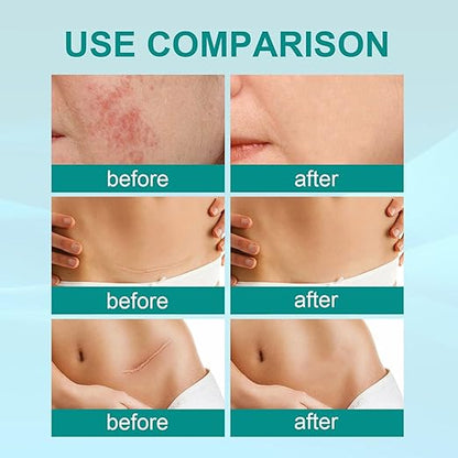 Before and after use comparison of Souqzila medical grade scar spray showing reduced redness and scar visibility